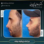 جراحی زیبایی بینی - دکتر تاج دینی-drtajdini.com