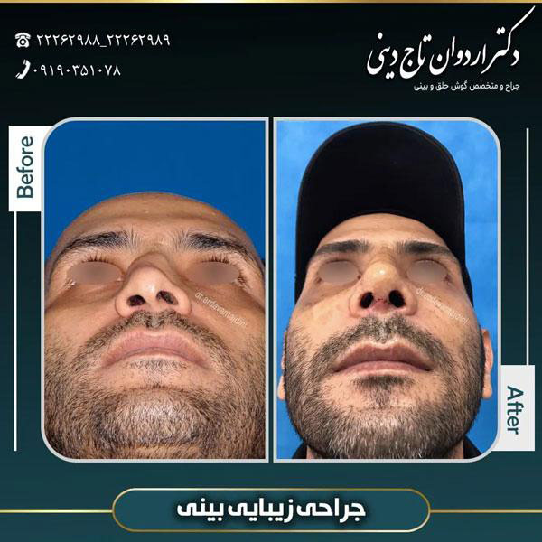جراحی بینی استخوانی | دکتر تاج دینی-drtajdini.com