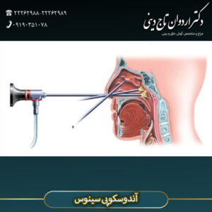 اندوسکوپی سینوس - دکتر اردوان تاج دینی-drtajdini.com