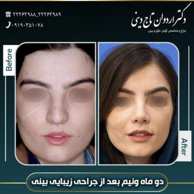 جراحی بینی طبیعی - دکتر اردوان تاج دینی-drtajdini.com