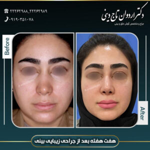 جراحی بینی طبیعی - دکتر تاج دینی