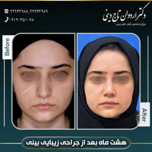 جراحی بینی طبیعی - دکتر تاج دینی