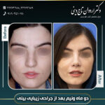 جراحی بینی گوشتی - دکتر تاج دینی