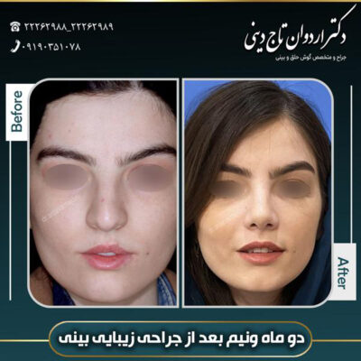 جراحی بینی گوشتی - دکتر تاج دینی-drtajdini.com