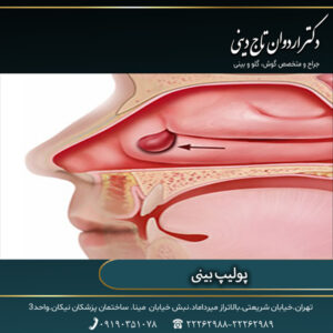 پولیپ بینی- تاج دینی