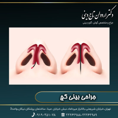 جراحی بینی کج - دکتر اردوان تاج دینی-drtajdini.com