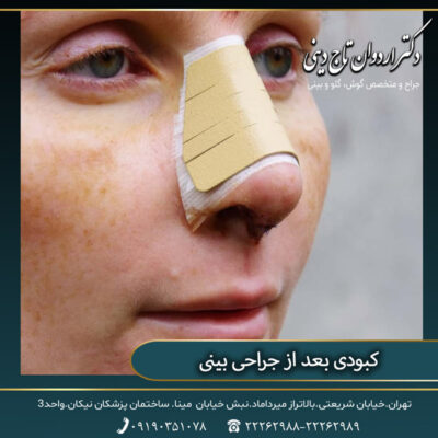 کبودی بعد از جراحی بینی - دکتر اردوان تاج دینی-drtajdini.com