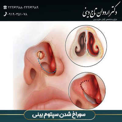 سوراخ شدن سپتوم بینی- دکتر تاج دینی - drtajdini.com