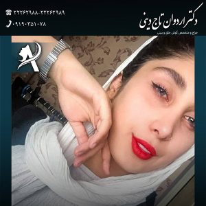 جراحی بینی نیمه فانتزی 1 - دکتر اردوان تاج دینی