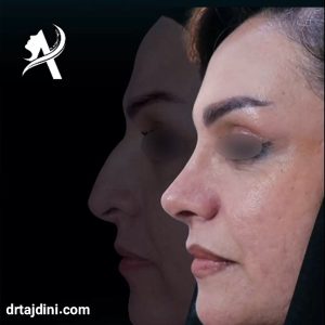 عکس نمونه کار عمل بینی گوشتی - دکتر تاج دینی - drtajdini.com
