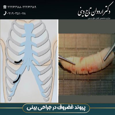 پیوند غضروف در عمل بینی - دکتر اردوان تاج دینی -drtajdini.com
