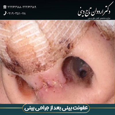 عفونت بینی بعد از عمل - دکتر اردوان تاج دینی -drtajdini.com