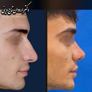 عکس جراحی بینی گوشتی - دکتر تاج دینی- drtajdini.com