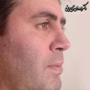 عکس عمل بینی گوشتی - دکتر اردوان تاج دینی-drtajdini.com