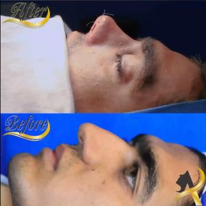 جراحی بینی کج - دکتر تاجدینی -drtajdini.com