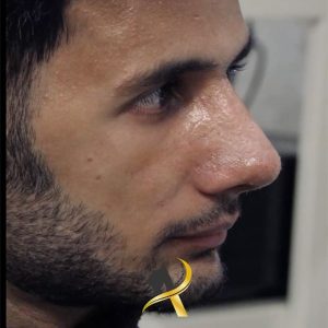 عکس جراحی بینی کج - دکتر تاج دینی - drtajdini.com