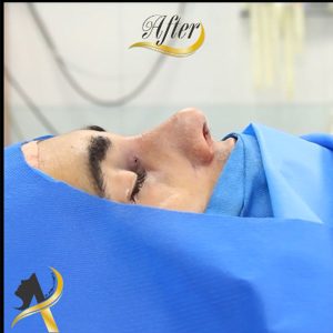 عکس رینوپلاستی بینی کج - دکتر تاج دینی - drtajdini.com