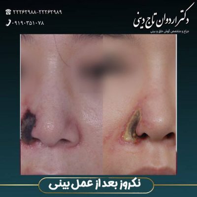 نکروز بینی بعد از عمل - دکتر تاج دینی - drtajdini.com