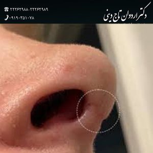 عکس اسکار بینی - دکتر اردوان تاج دینی - drtajdini.com