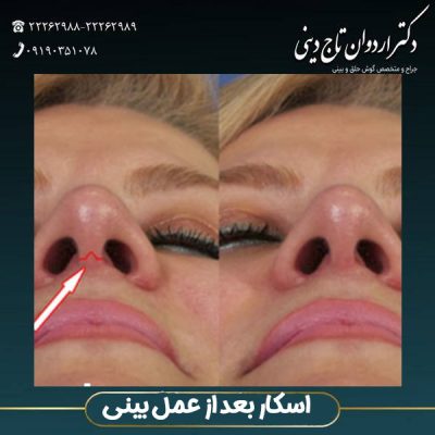 اسکار بعد از عمل بینی - دکتر اردوان تاج دینی -drtajdini.com
