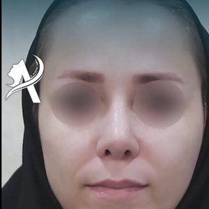 عکس عمل بنیی نچرال - دکتر اردوان تاج دینی - drtajdini.com