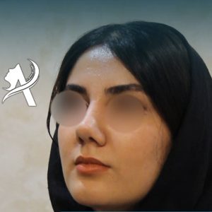 عکس عمل بینی طبیعی - دکتر تاج دینی - drtajdini.com