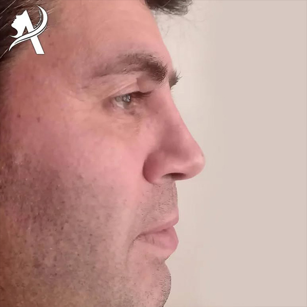 عکس نمونه کار جراحی بینی