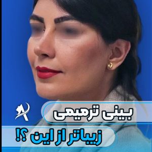 عکس نمونه جراحی عمل بینی ثانویه - دکتر تاج دینی -drtajdini.com