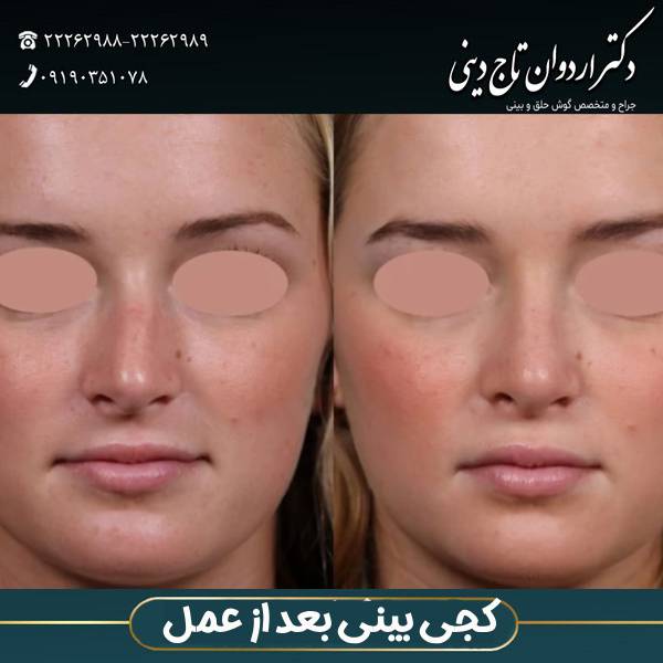 کجی بینی بعد از عمل