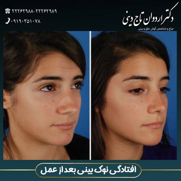 افتادگی نوک بینی بعد از عمل